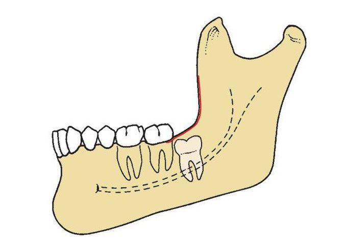 Pell and Gregory class C impaction.