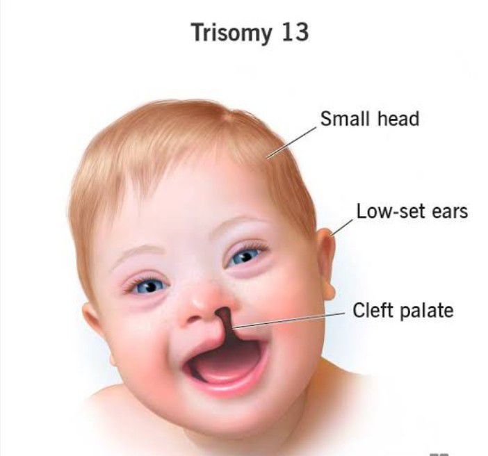 Trisomy 13 - MEDizzy