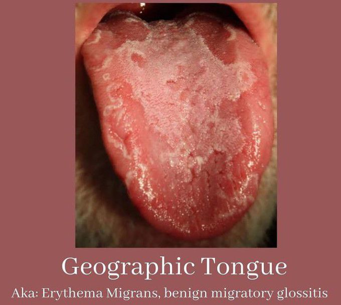 Geographic Tongue