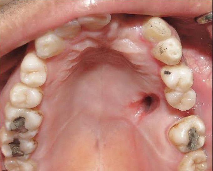 Oroantral fistula