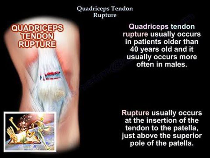 Quadriceps Tendon Rupture  - Everything You Need To Know - Dr. Nabil Ebraheim