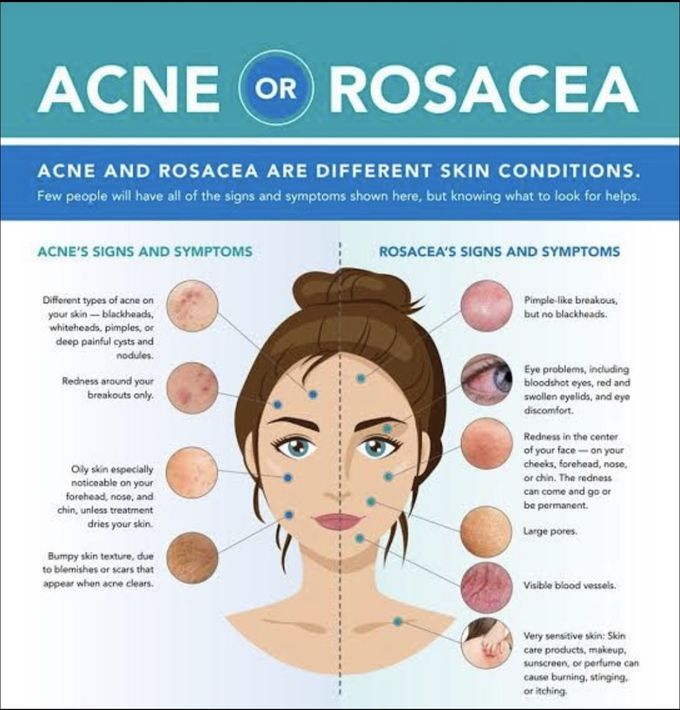 Rosacea