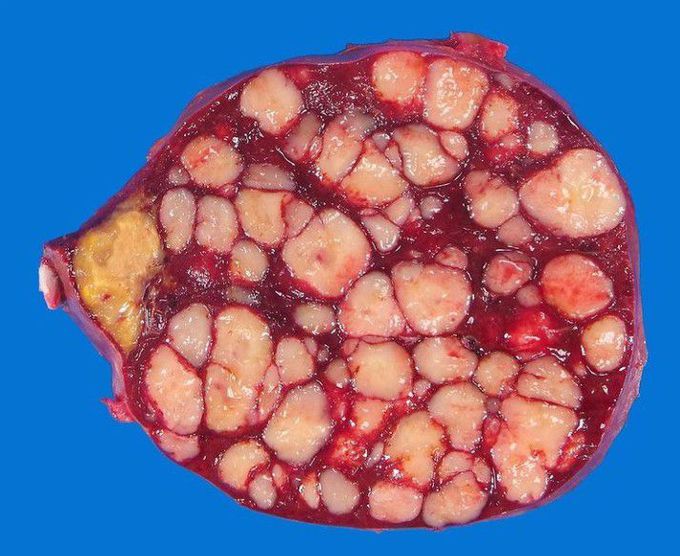Spleen nodules of diffuse large B-cell lymphoma