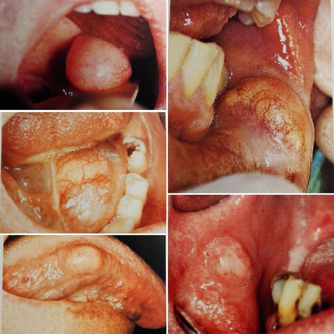 Lipoma