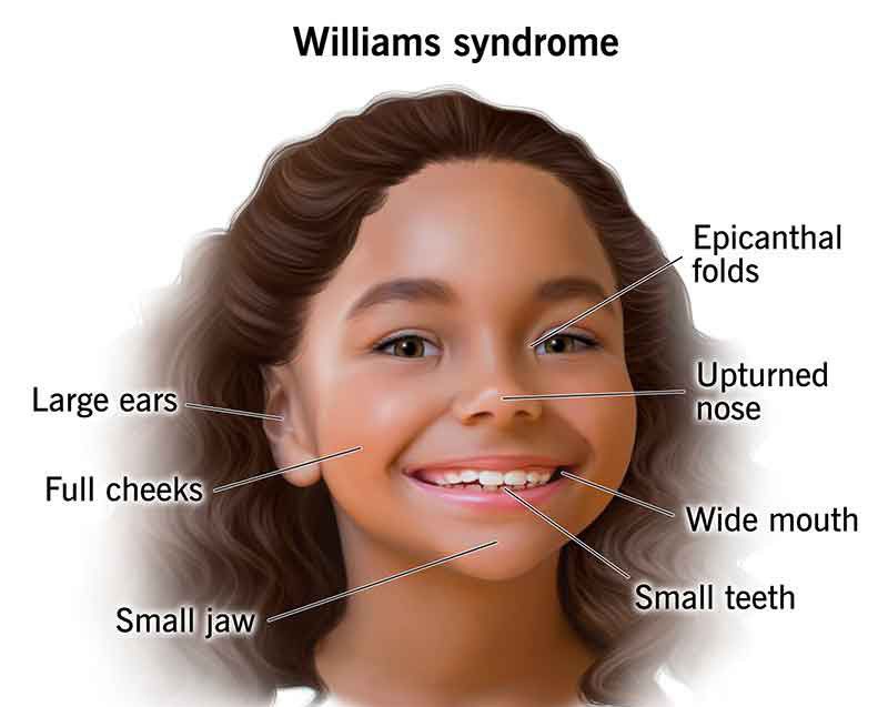 These are the symptoms of Williams syndrome - MEDizzy