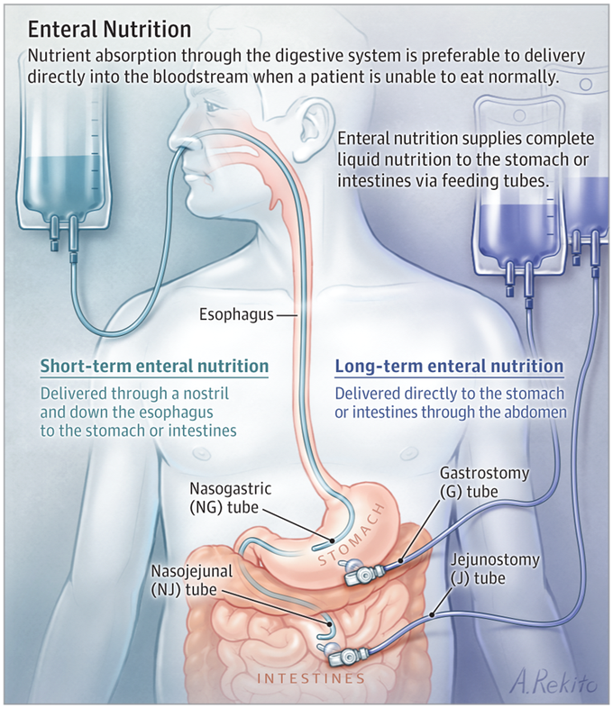 Type of Intubation