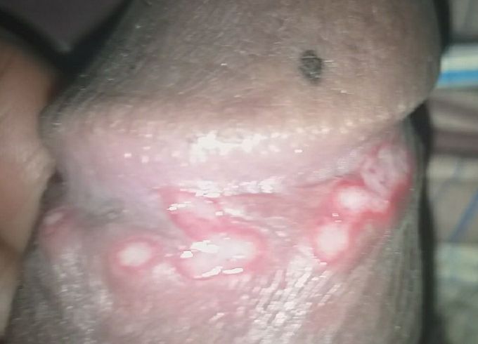 Coronal lesions on Glans Penis
