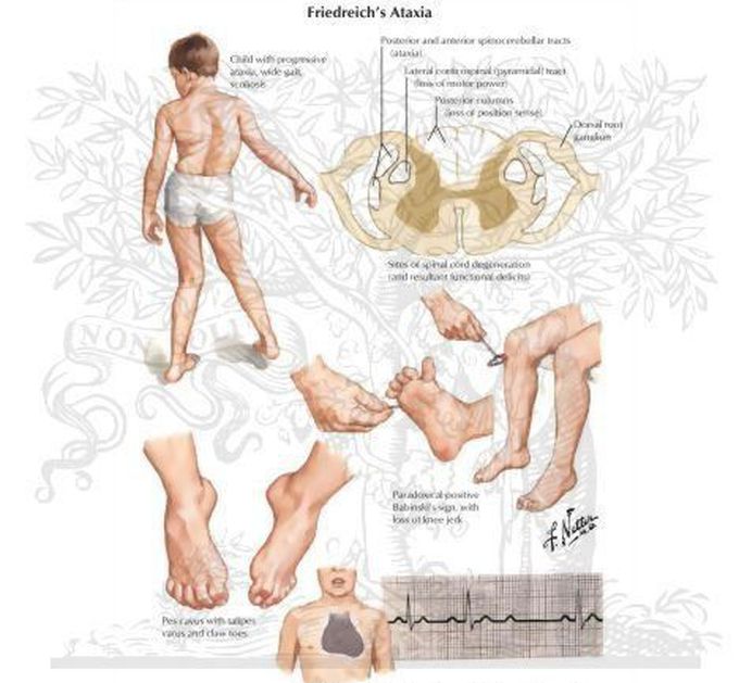 Symptoms of Fiiedreich ataxia