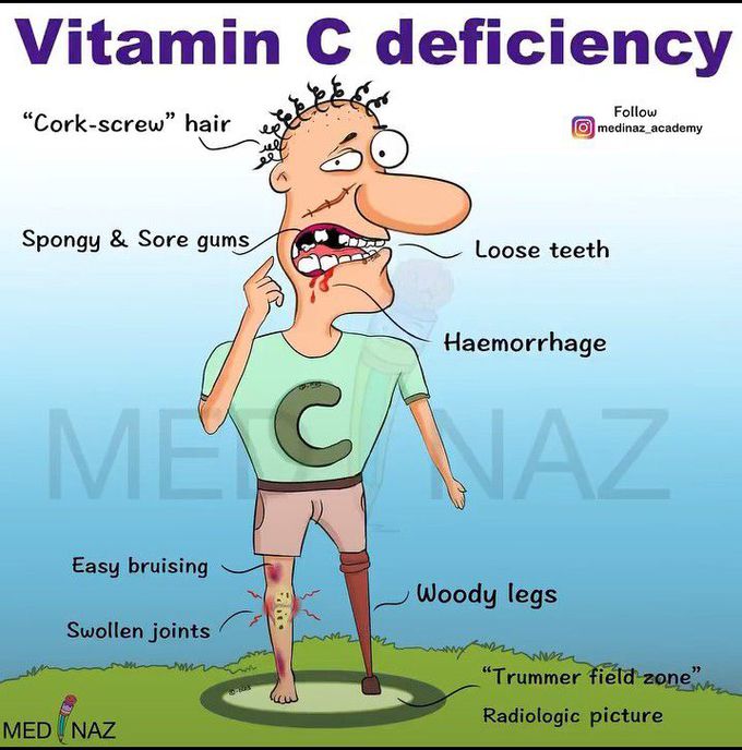 Vitamin C Deficiency