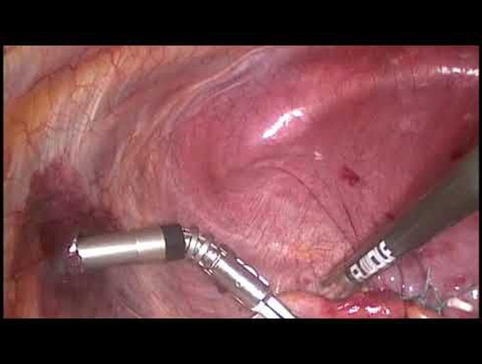 FlexDex™ Needle Holder Used to Perform a Diaphragm Plication