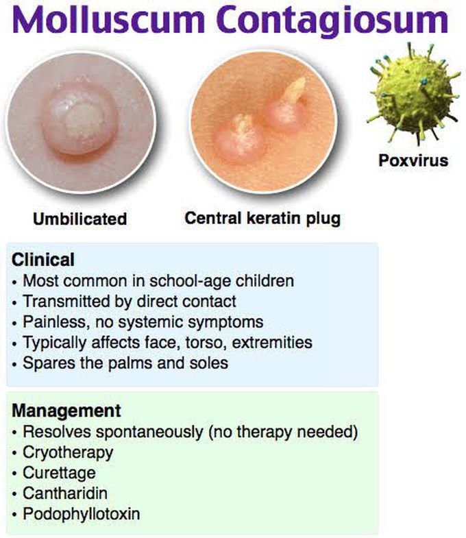 Molluscum Contagiosum