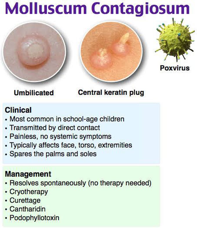 What Causes Molluscum Virus Molluscum Surinfect GIBBG
