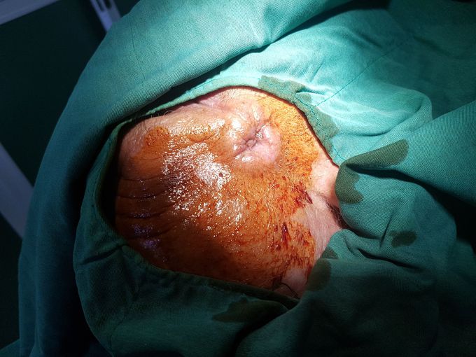 Basal cell carcinoma