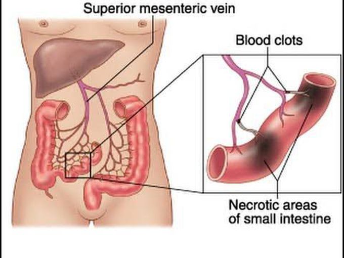 What is mesentric ischemia?