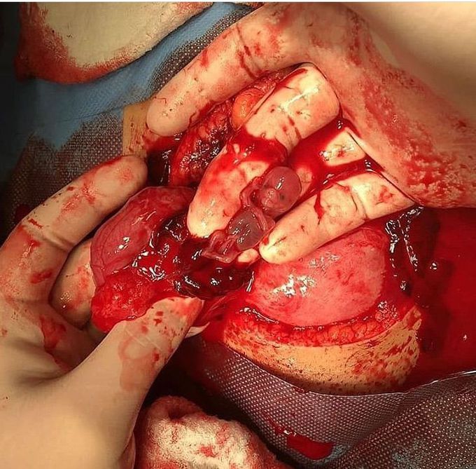 Fetus post abortion, goodbye buddy