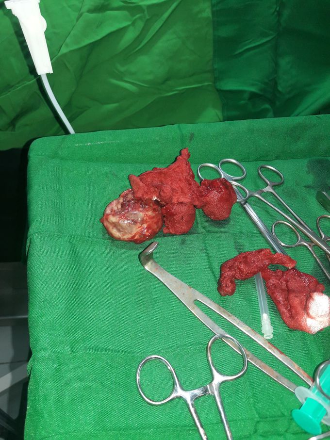 Thyroidectomy