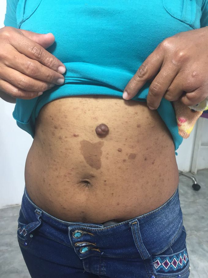 Neurofibromatosis