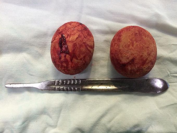 Bladder stones
