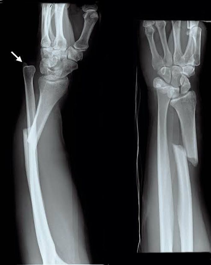 Nightstick fracture