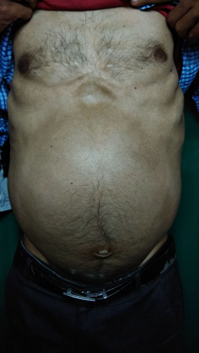 Case Of Chronic Myaloid Leukaemia with Huge Splenomegaly !!