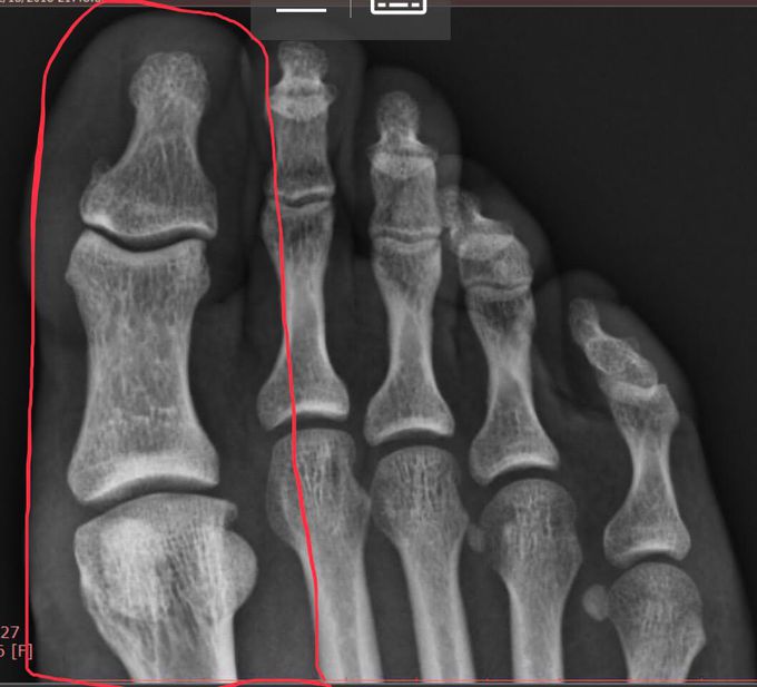 Injured right foot 1st Proximal Phalanx