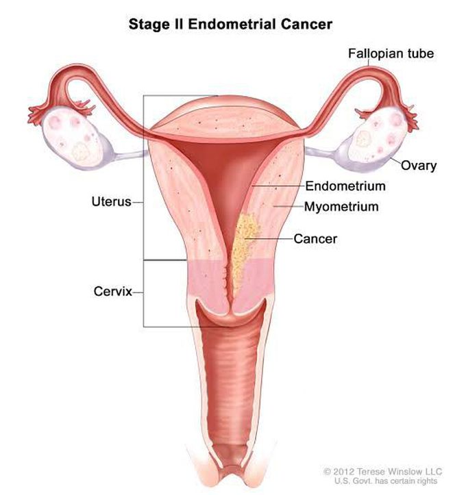 Causes of endometrial carcinoma