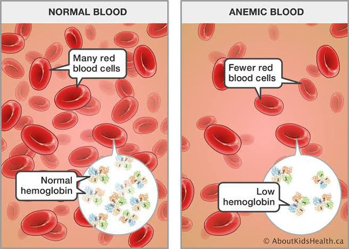 What is Anemia?