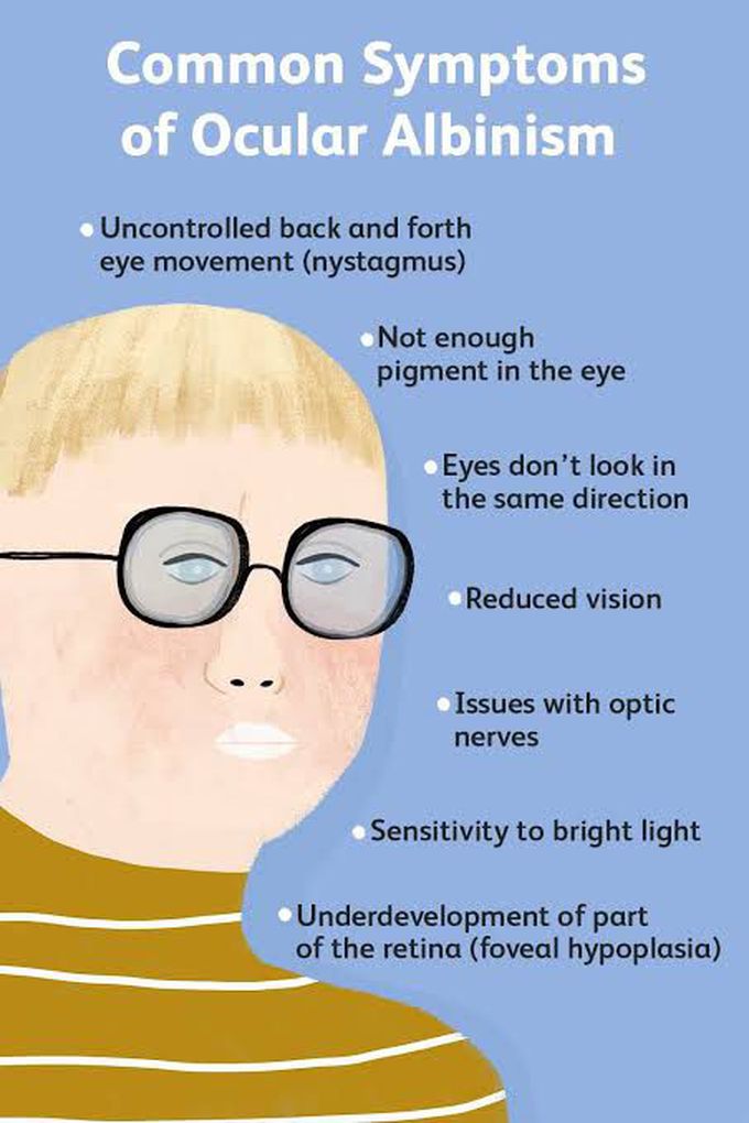 These are the symptoms of Ocular albinism