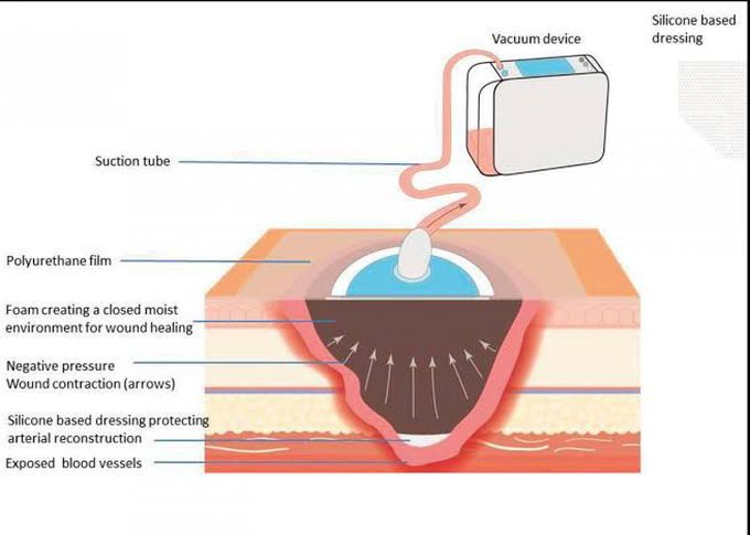 Negative Pressure Wound Therapy