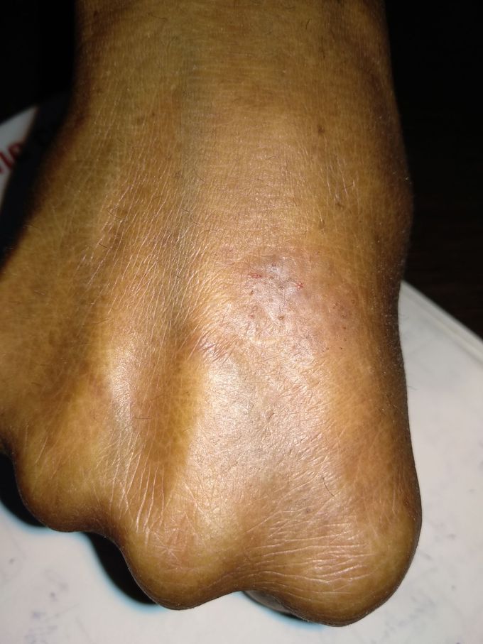Skin disease