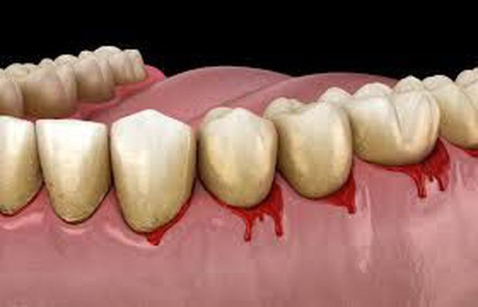 Prevention of bleeding gums