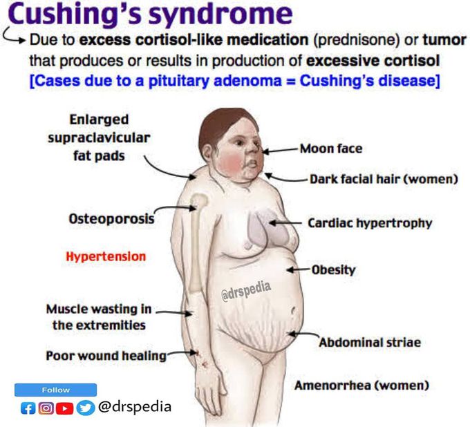 Cushing's Syndrome