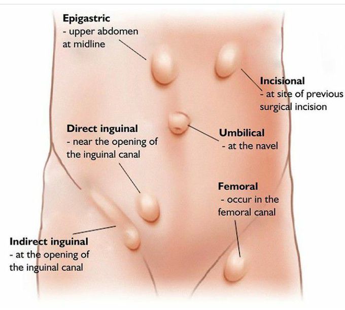 Hernias and locations