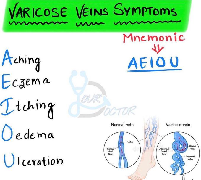 Varicose Veins