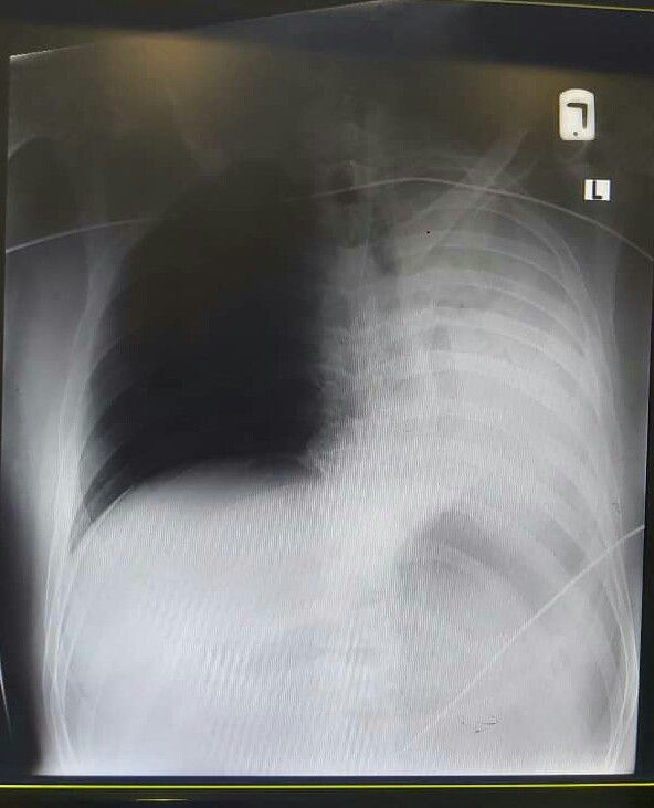 Rupture of diaphragm - MEDizzy