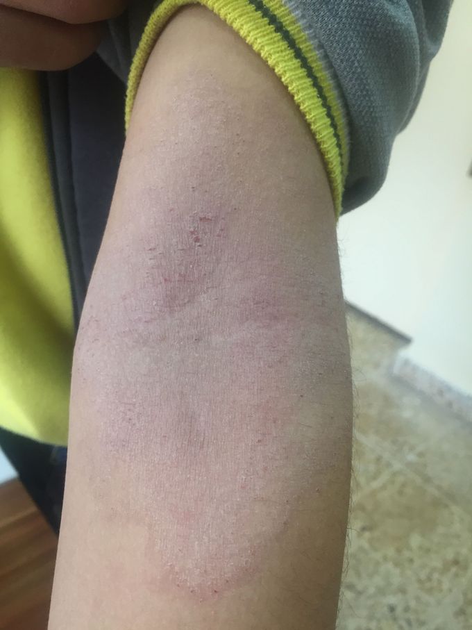 Allergy