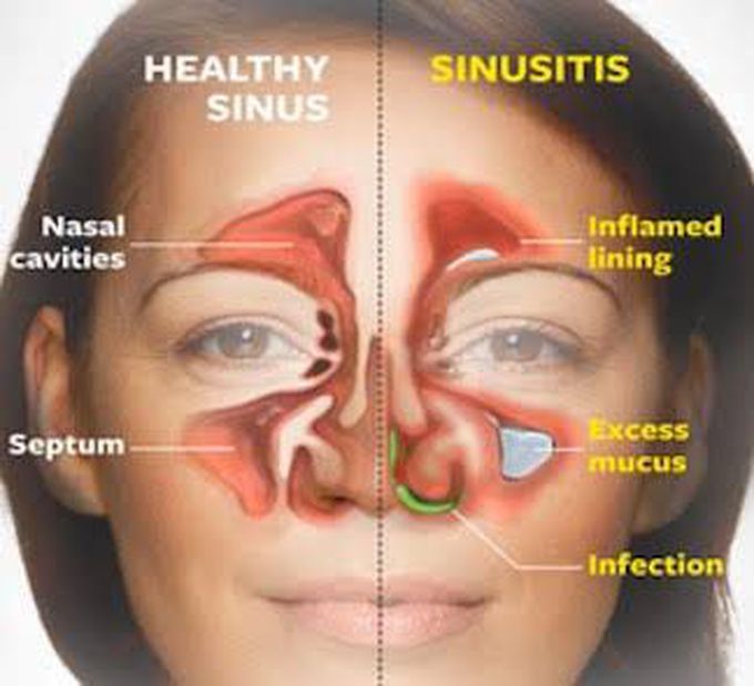 Sinusitis