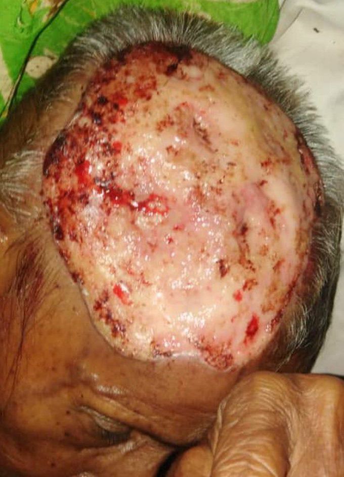 70years old neglected female with recurrent itchy scalp lesion that's involves almost all of it..?