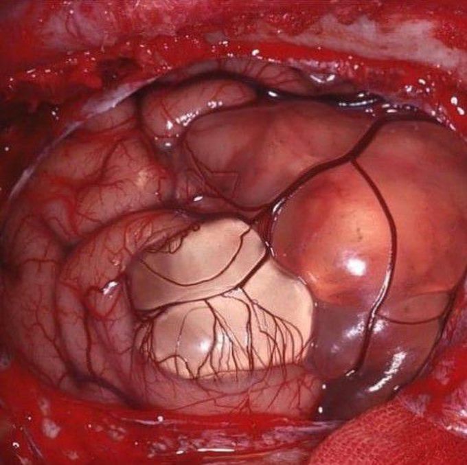 Arachnoid cyst