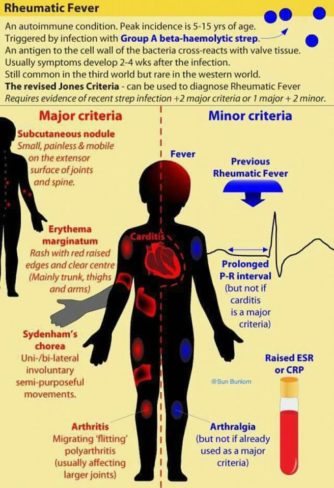 Rheumatic fever