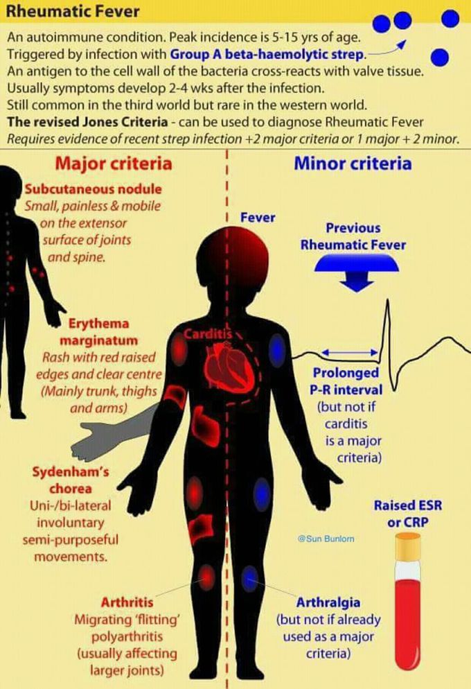 Rheumatic fever