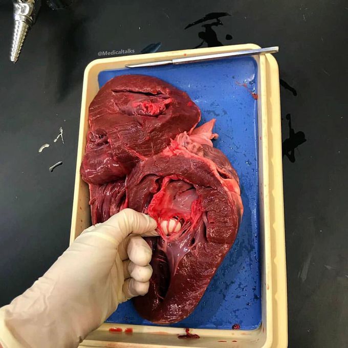 Chordae tendinae