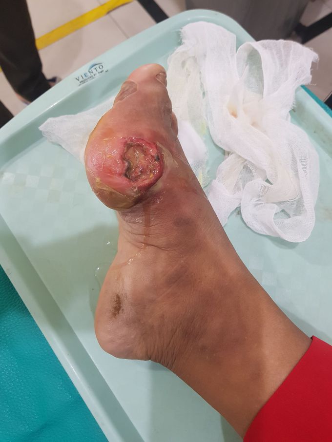 Ulcus diabeticum