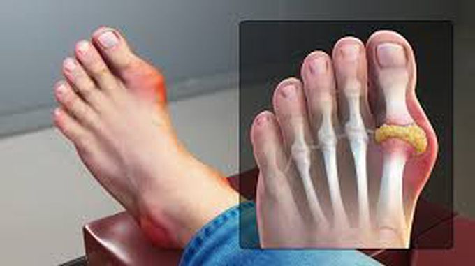 Symptoms of gout