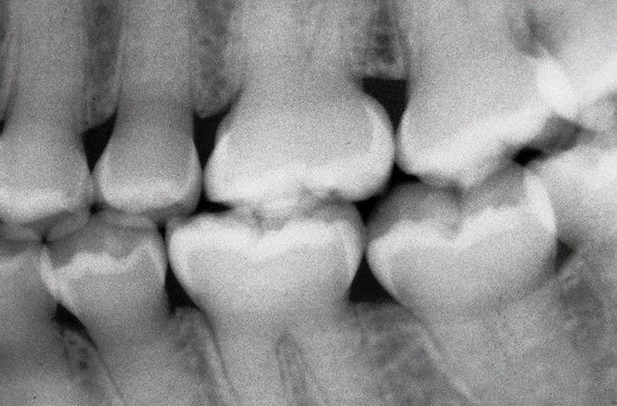  Dentinogenesis Imperfecta (DGI).