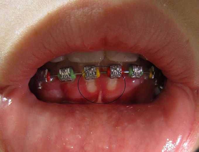 Differential diagnosis for primary herpetic gingivostomatitis