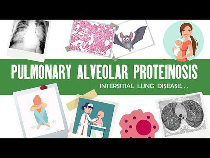 Pathology of Pulmonary Alveolar Proteinosis (PAP)