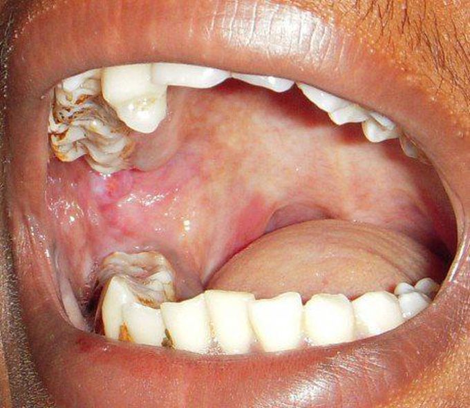 Oral Submucous Fibrosis