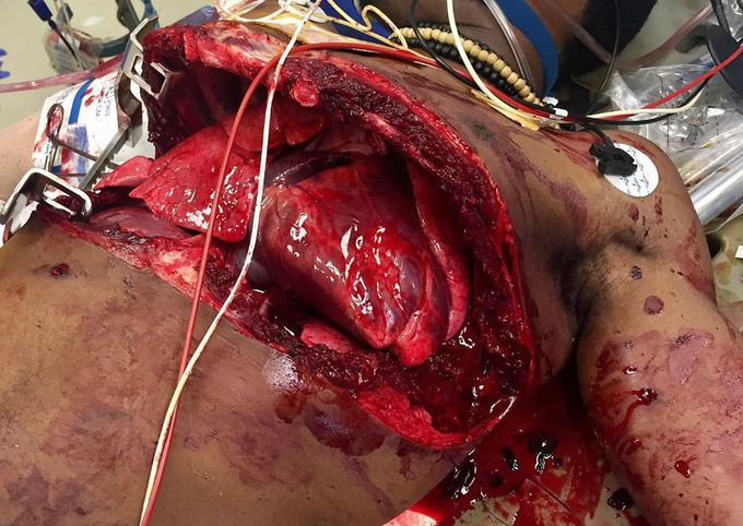 A Clamshell (bilateral anterior) thoracotomy performed due to a high velocity round to the chest that went through and through from right to left crossing the midline! 
