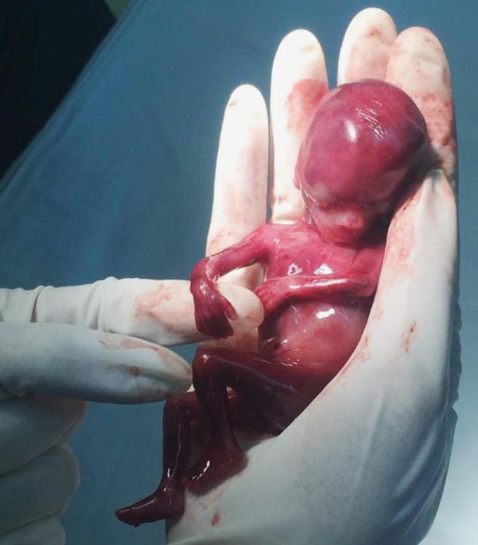 Spontaneous abortion of 17 weeks fetus